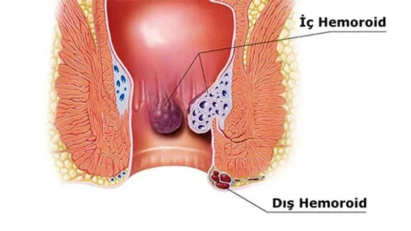 Hemoroid nedir